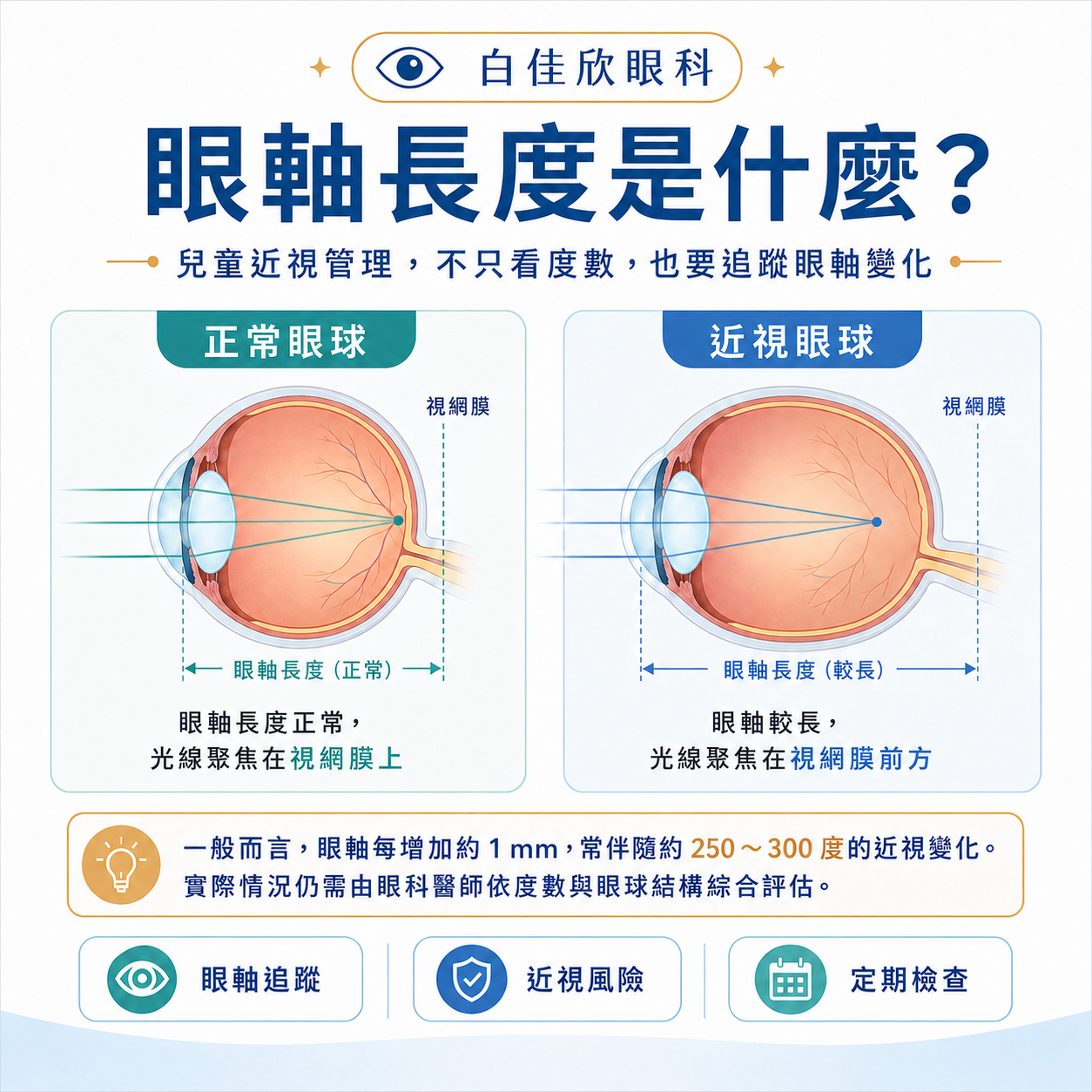 兒童近視眼軸長度變化示意圖,比較正常眼球與近視眼球的光線聚焦位置
