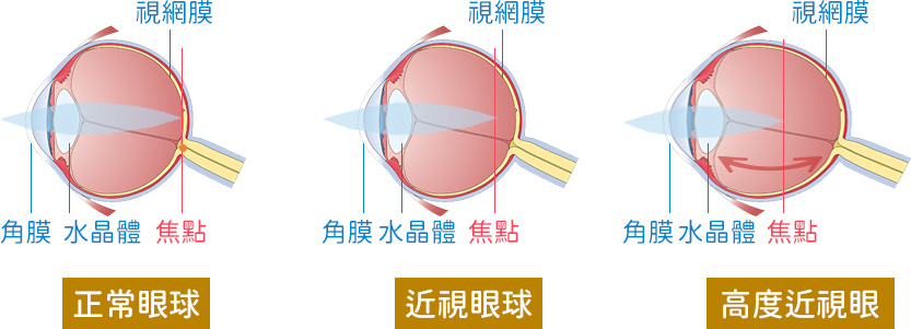 近視眼球與正常眼球的比較圖 近視眼球與正常眼球的比較圖