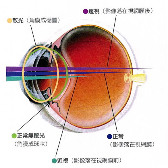 近視、散光、遠視示意圖 近視、散光、遠視示意圖