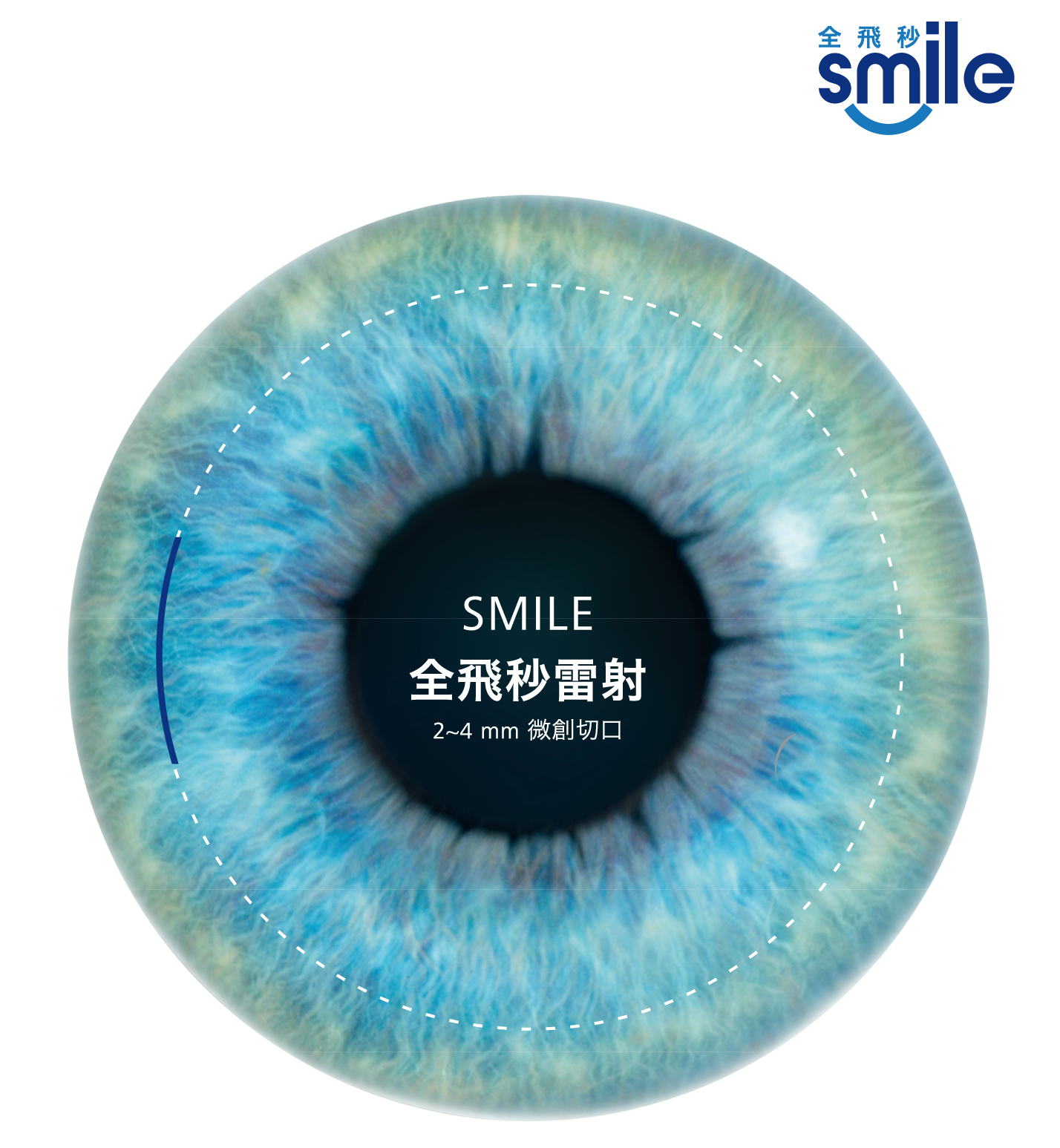 SMILE 全飛秒近視雷射手術原理：2~4mm微創切口