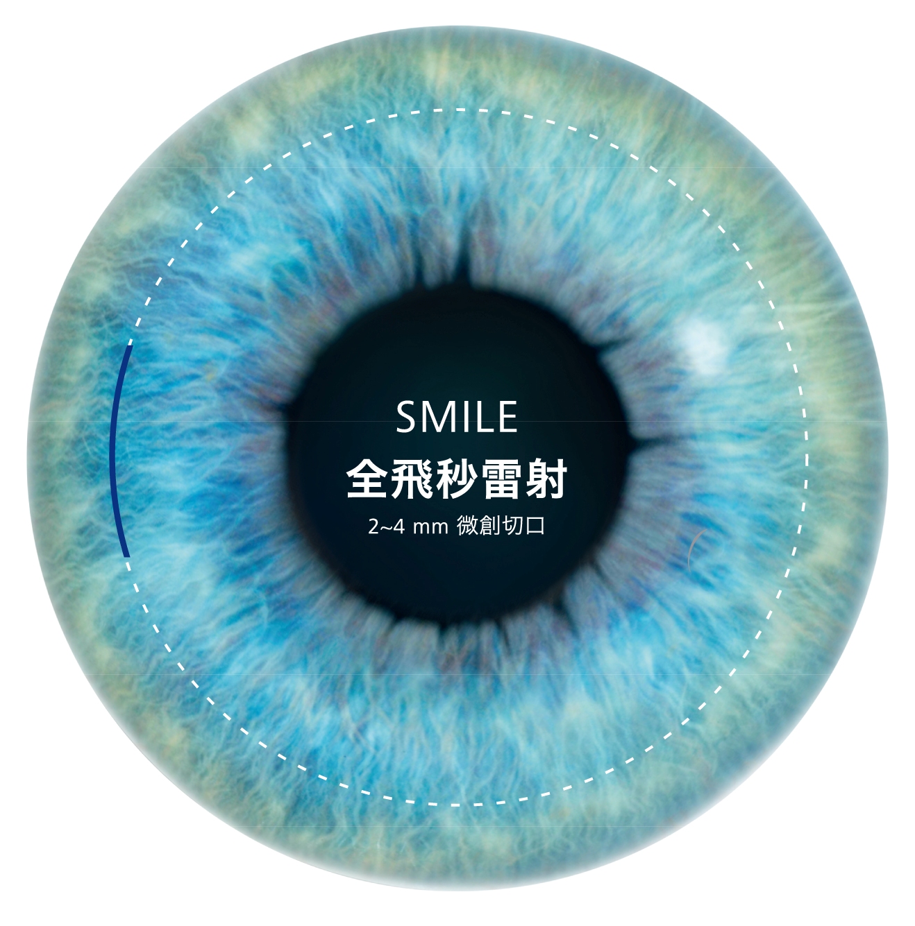 為什麼要選擇Smile全飛秒雷射原因一：微創傷口
