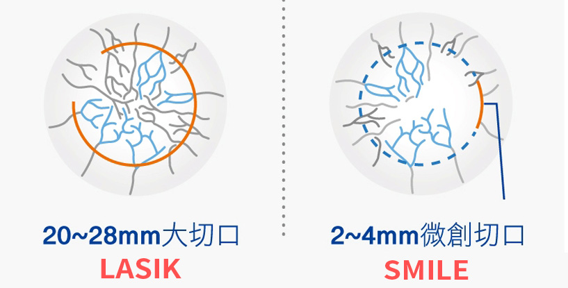為什麼要選擇Smile全飛秒雷射原因三：降低乾眼機率