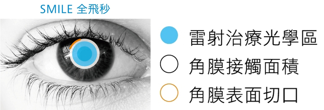 為什麼要選擇Smile全飛秒雷射原因四：恢復快