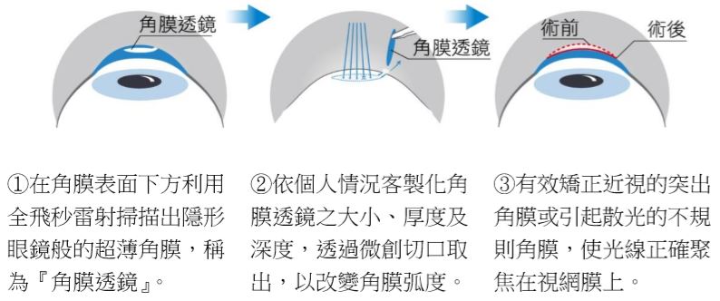 近視散光‧全程一機完成