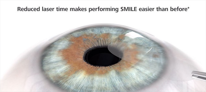 SMILE Pro2.0全飛秒近視雷射：雷射掃描更綿密，讓製作透鏡及取出透鏡的時間更短，更舒適且降低風險