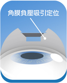SMILE Pro 2.0全飛秒雷射手術步驟：角膜負壓吸引定位