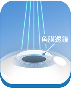 SMILE Pro 2.0全飛秒雷射手術步驟：製作角膜透鏡