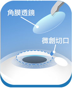 SMILE Pro 2.0全飛秒雷射手術步驟：取出角膜透鏡