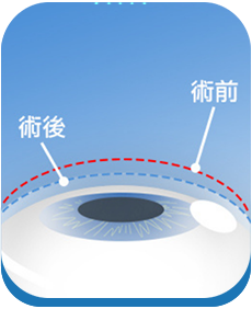 SMILE Pro 2.0全飛秒雷射手術步驟：完成矯正