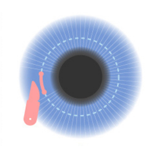 第三代SMILE Pro 2.0矯正方式：2~4mm微創切口