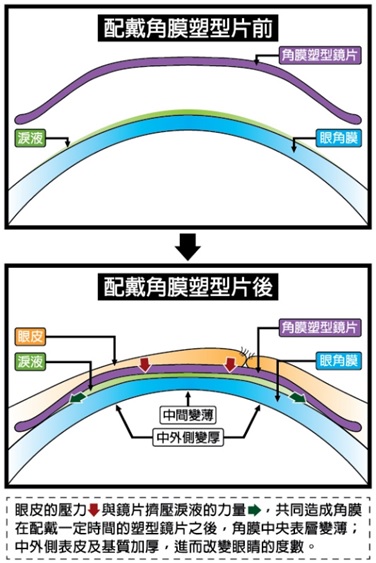 角膜塑型片近視矯正原理 角膜塑型片近視矯正原理