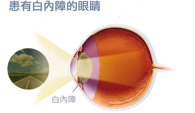 患有白內障的眼睛 患有白內障的眼睛