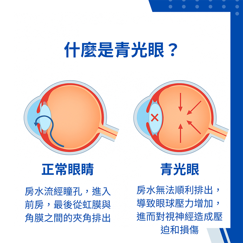 什麼是青光眼? 什麼是青光眼?