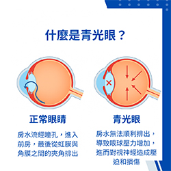 青光眼會好嗎？症狀、原因、治療與常見問題一次看懂