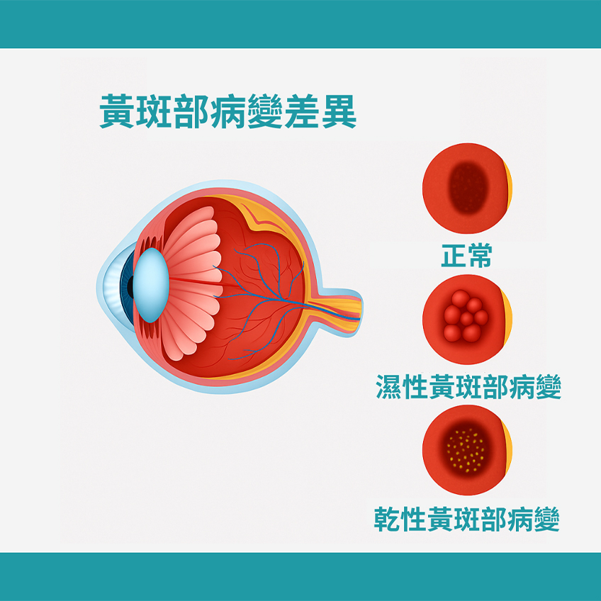 黃斑部病孌差異 黃斑部病孌差異