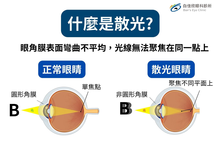 什麼是散光？