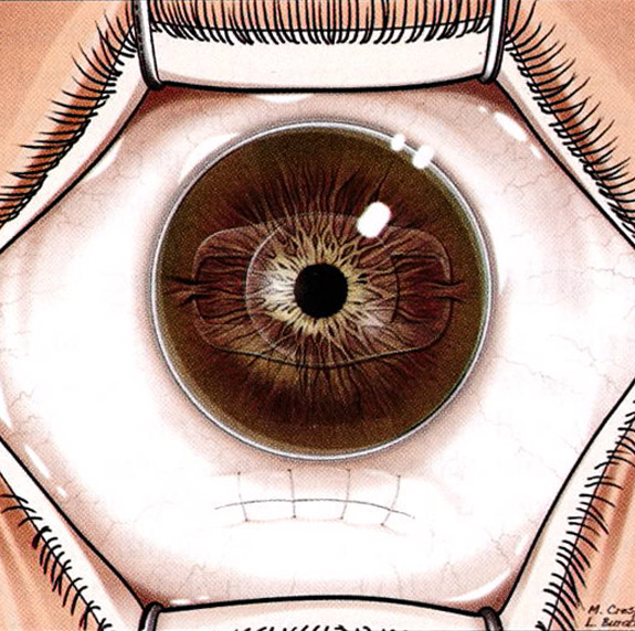 植入式微型鏡片的手術過程：手術完成，鏡片固定於瞳孔中心位置。